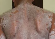 PSORIASIS-2