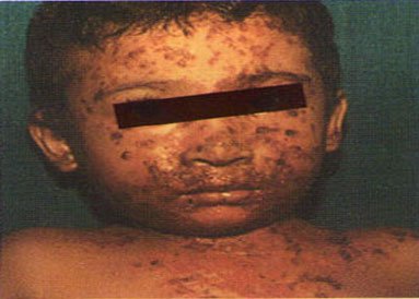 impetigo_1