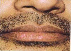 lip_vitilogo3